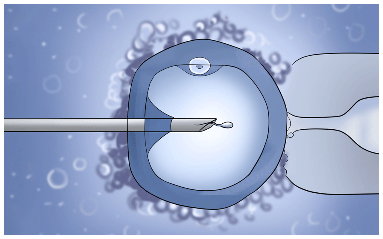 Intracytoplasmic Sperm Injection Icsi Infertility Treatment Jalgaon